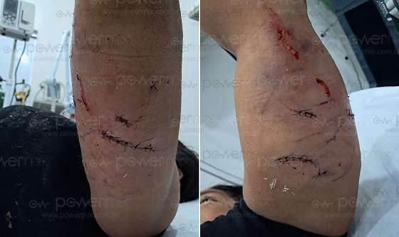 Mulher é atacada por cachorro ao tentar proteger pets e fica ferida em MT; Veja vídeo